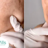 Cystic Acne: Understanding, Types, Causes, Effective Herbal Remedies, and Prevention