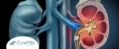 Kidney Stones: Signs, Causes, and Treatment Options
