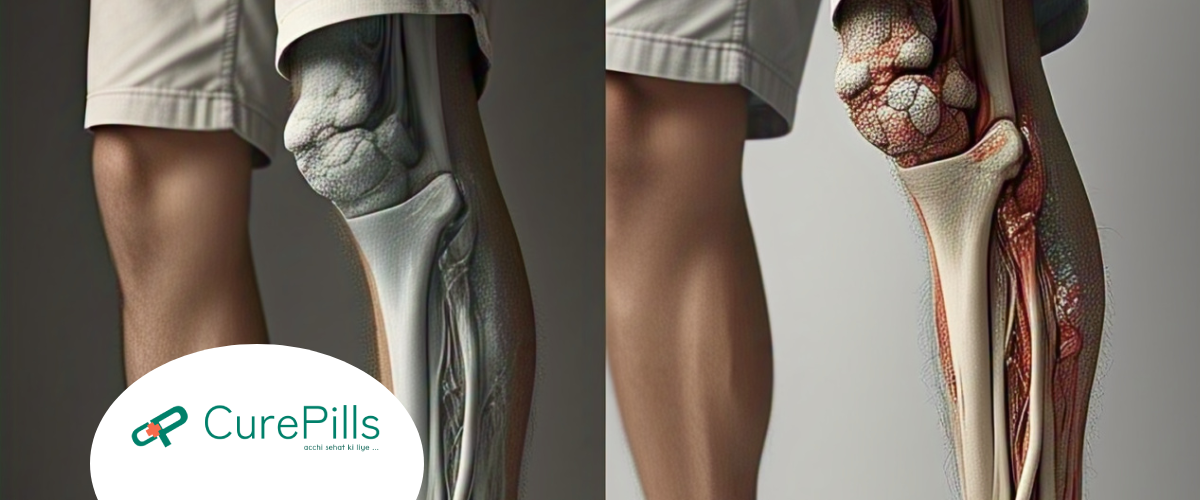 Top Natural Ways to Manage Uric Acid and Prevent Gout